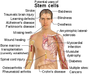 Diseases and conditions where stem cell treatm...