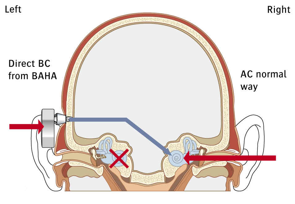 Bone Anchored Hearing Aids (BAHA)