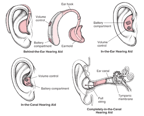 TYPES OF HEARING AIDS