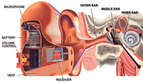 HEARING AID PLACEMENT